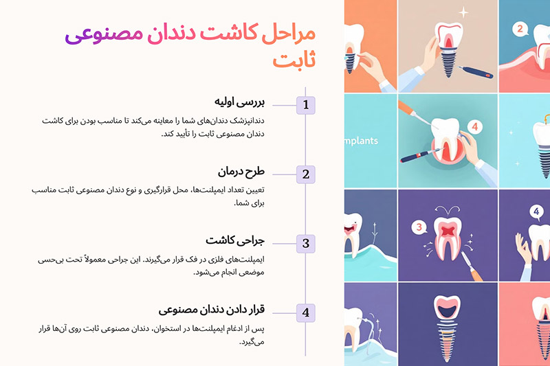 مراحل-کاشت-دندان-مصنوعی-ثابت