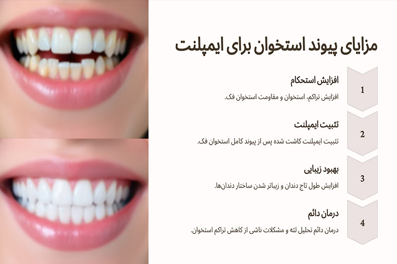 مزایای-پیوند-استخوان-دندان-برای-ایمپلنت