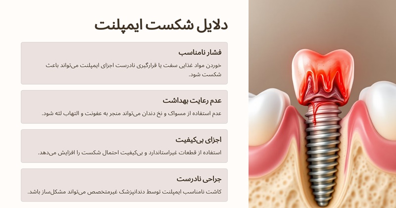چه دلایلی موجب شکست اجزای ایمپلنت دندان می شود