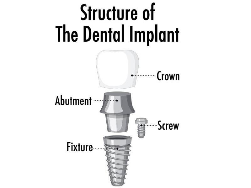 اجزای ایمپلنت دندان