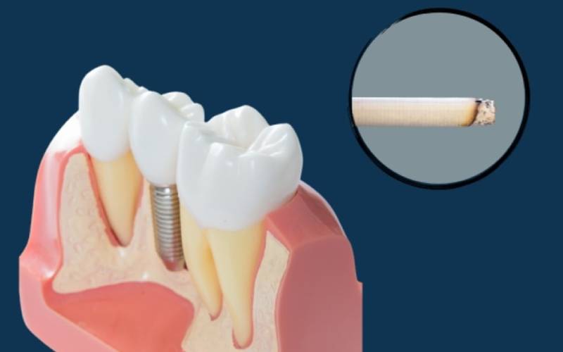 توصیه های مراقبتی برای کاشت ایمپلنت در افراد سیگاری