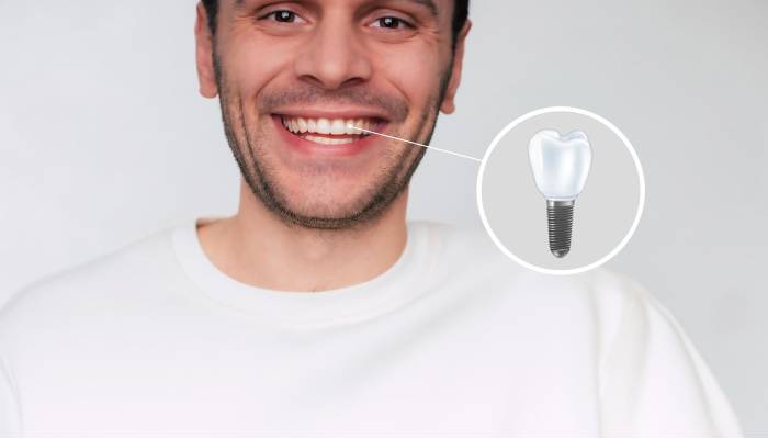 شرایط خاص برای ایمپلنت دندان های جلو