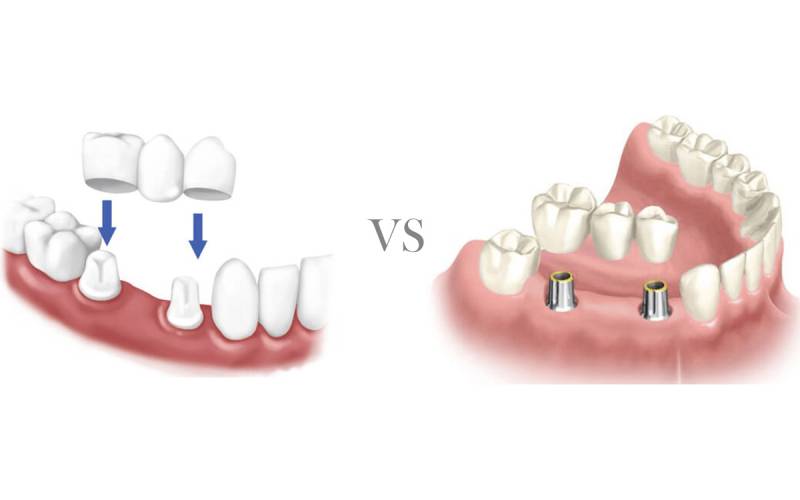 مقایسه مزایای ایمپلنت و بریج دندان