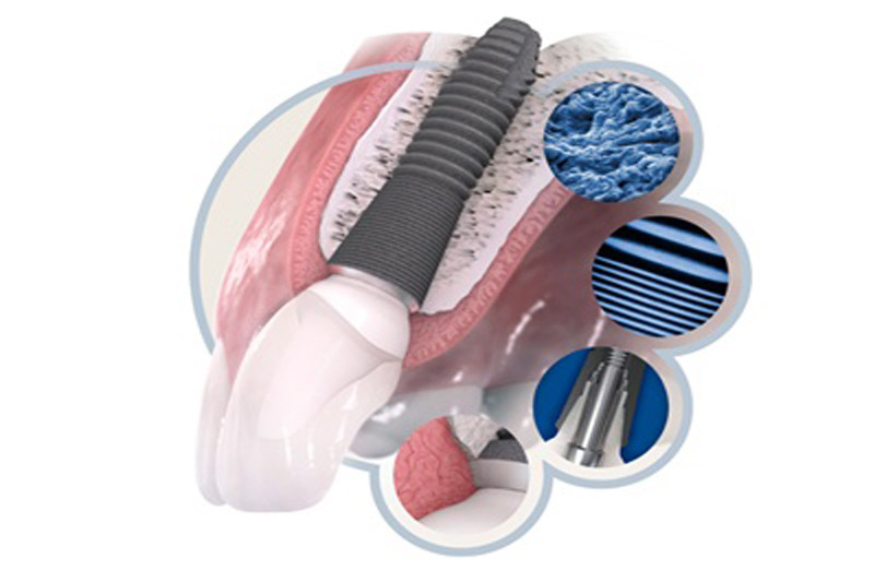 ایمپلنت-آمریکایی-آستراتک