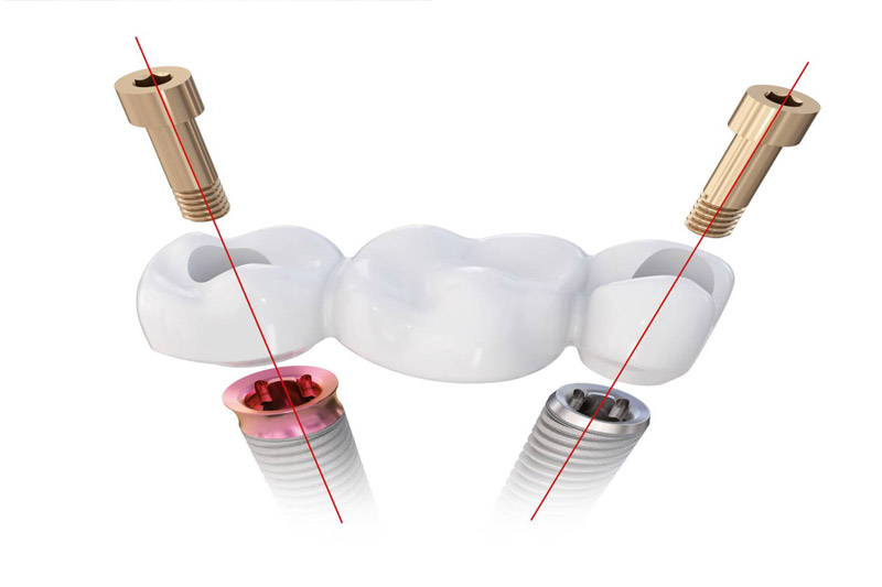 ایمپلنت-تی‌‌آر‌آی-(TRI)