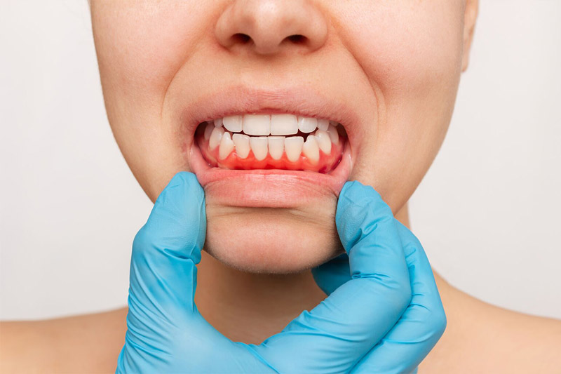 بوی-بد-دهان-با-عفونت-لثه