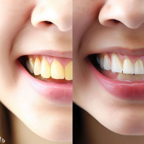 سفید کردن دندان در خانه