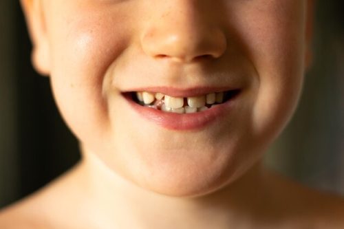 عوارض بی دندانی