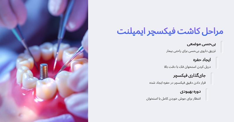 نحوه کاشت فیکسچر ایمپلنت چگونه است؟