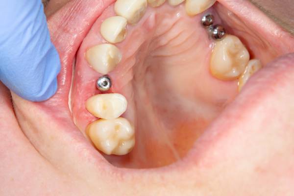 عفونت ایمپلنت دندان چیست؟