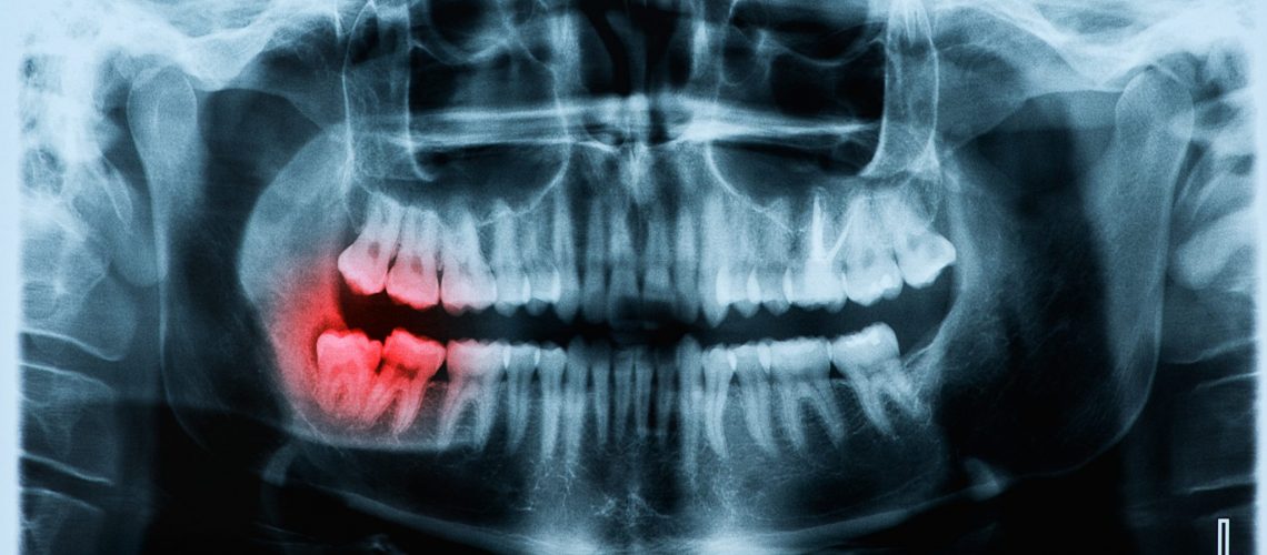 ورم بعد از ایمپلنت دندان