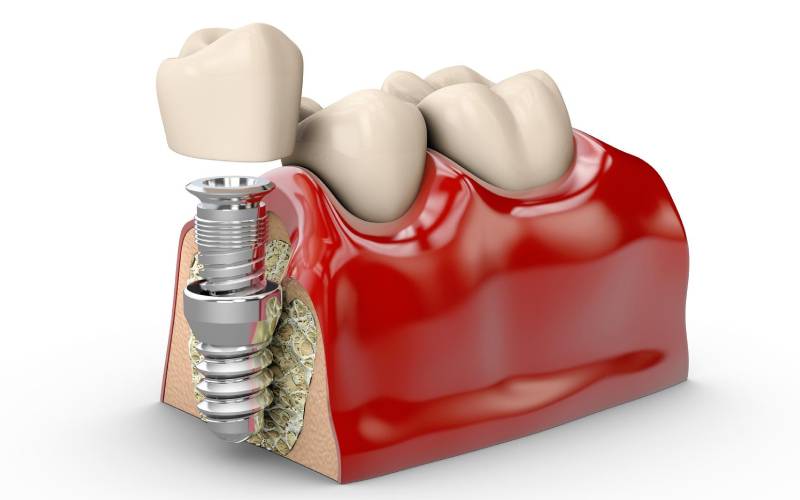 قیمت ایمپلنت کره‌ای