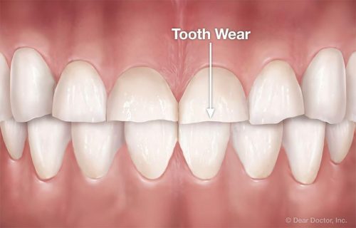 ساییده شدن دندان
