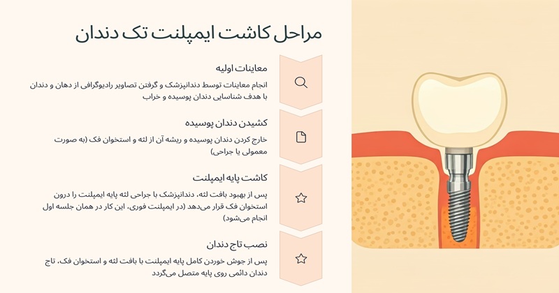 مراحل ایمپلنت تک دندان چگونه است؟