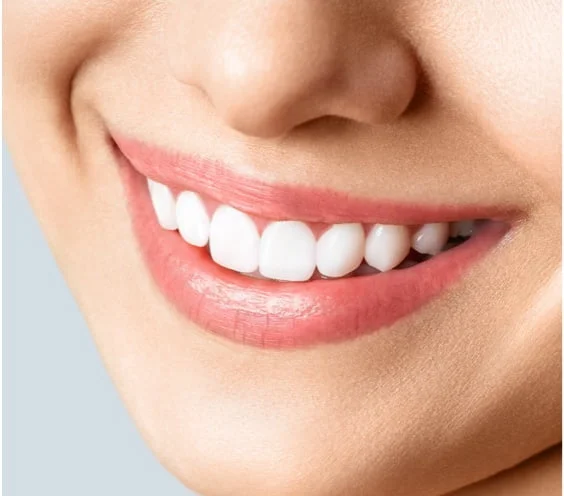 روکش ایمپلنت