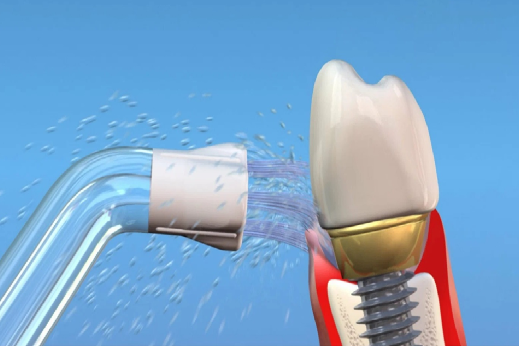 دهانشویه مخصوص ایمپلنت