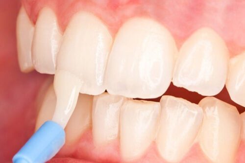 فواید-فلوراید-تراپی-برای-دندان‌ها