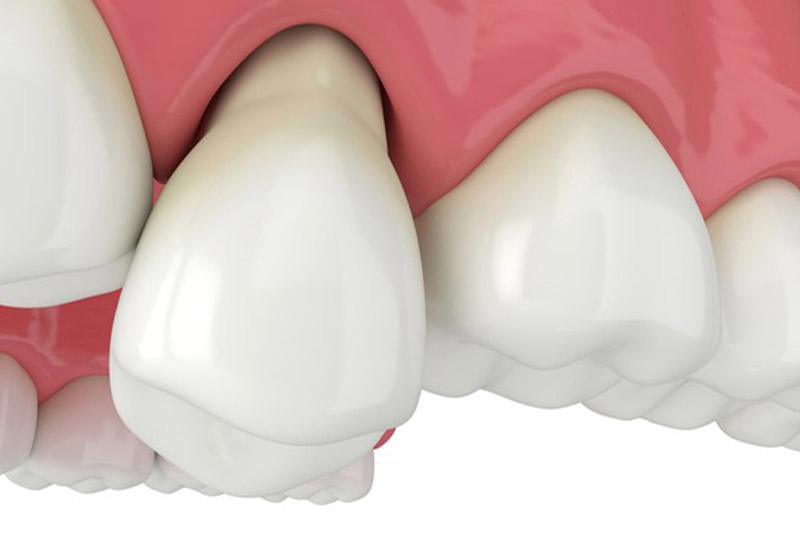 ایمپلنت-بهتر-است-یا-روکش