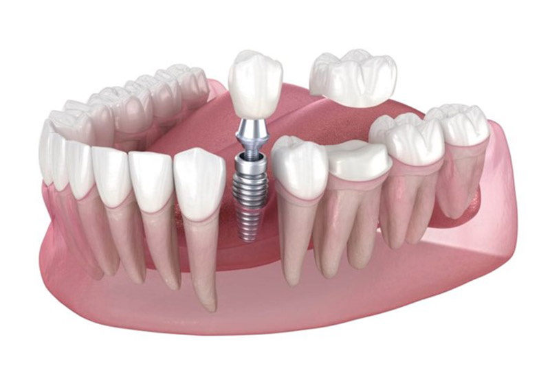 ایمپلنت-دندان-چیست