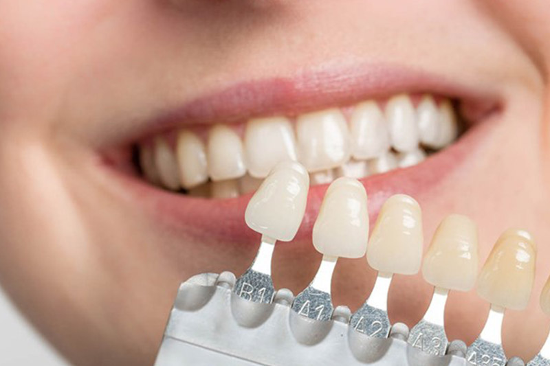 روکش-دندان-چیست