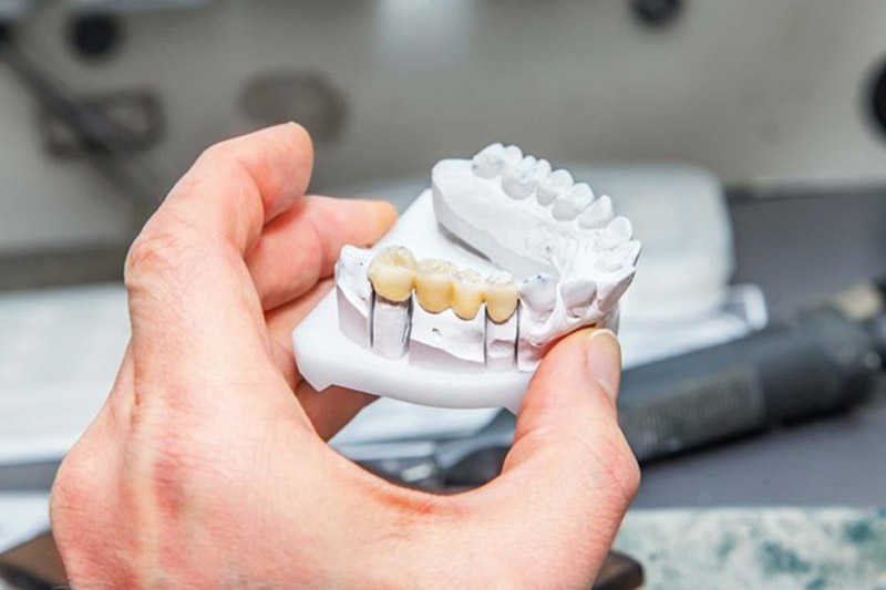 نصب-روکش-دندان-متصل-به-هم