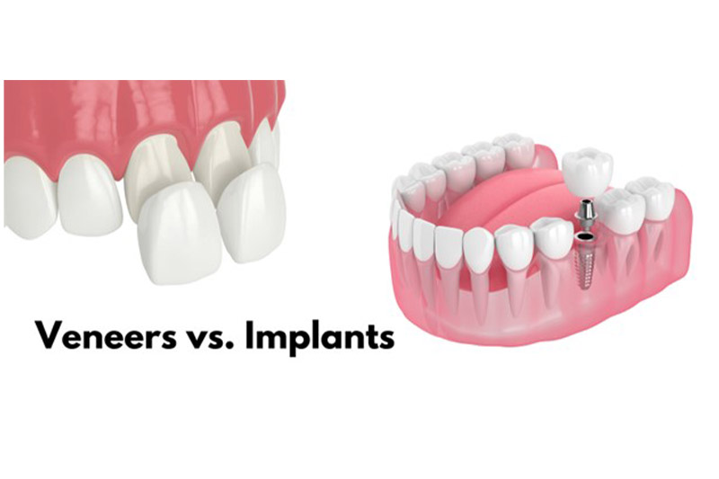 ایمپلنت-بهتر-است-یا-روکش