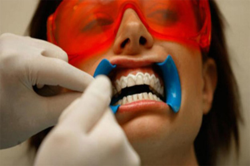 بلیچینگ-یا-سفیدکردن-دندان-