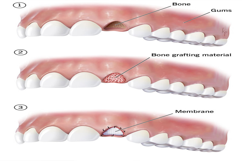 نحوه-تزریق-پودر-استخوان-در-لثه