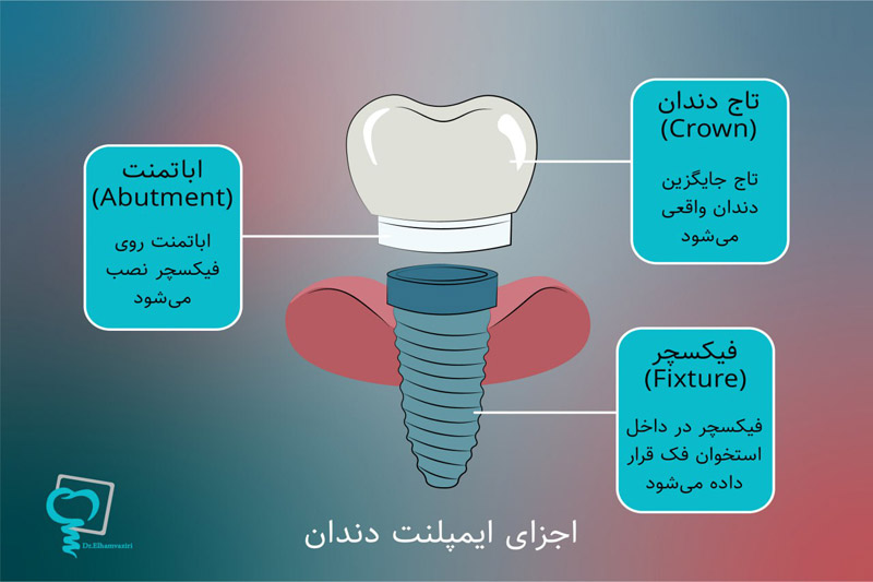 اجزای-ایمپلنت-دندان