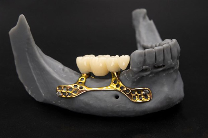 ایمپلنت‌های-ساب‌پریوستئال-
