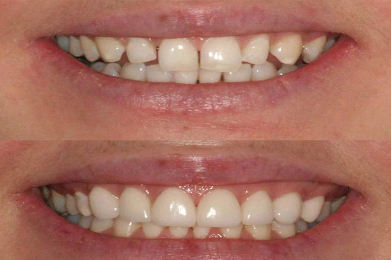 عکس-لمینت-دندان