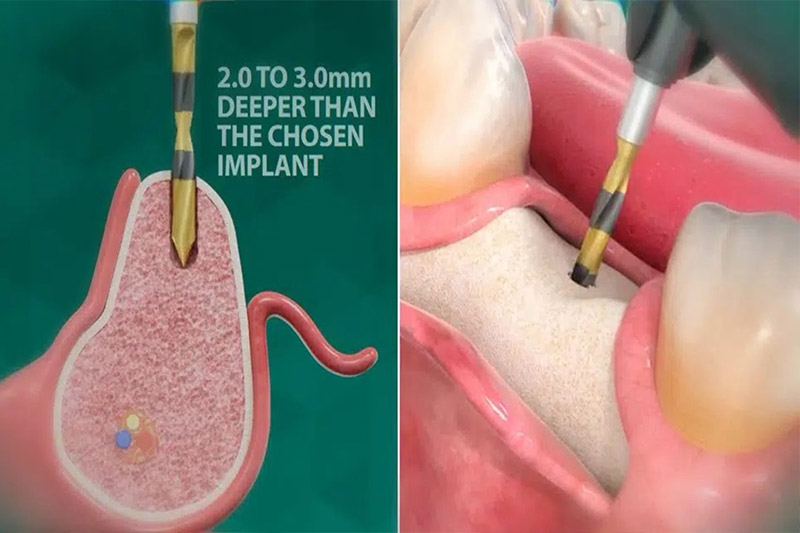 قراردادن-ایمپلنت