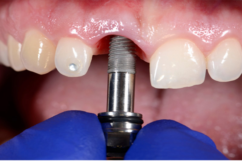 قراردادن-پیچ-ایمپلنت