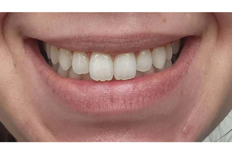 لمینت-دندان-خرگوشی-