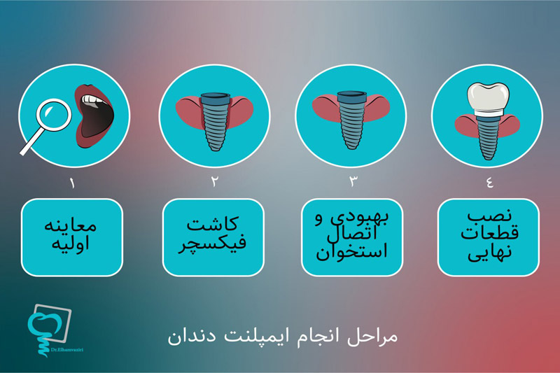 مراحل-انجام-ایمپلنت-دندان