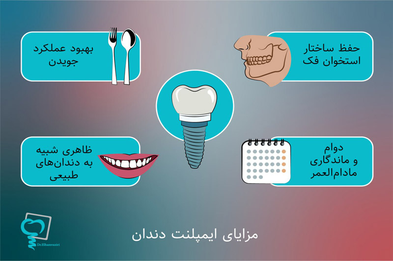 مزایای-ایمپلنت-دندان