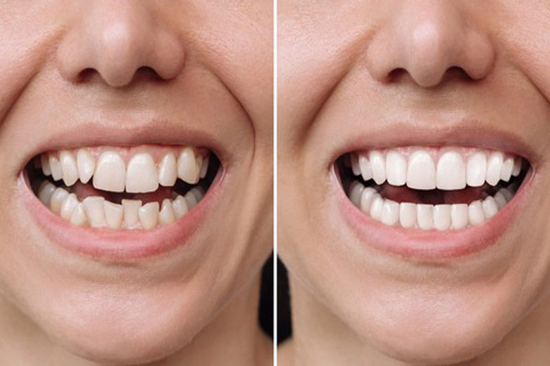 نمونه-کارهای-لمینت-دندان