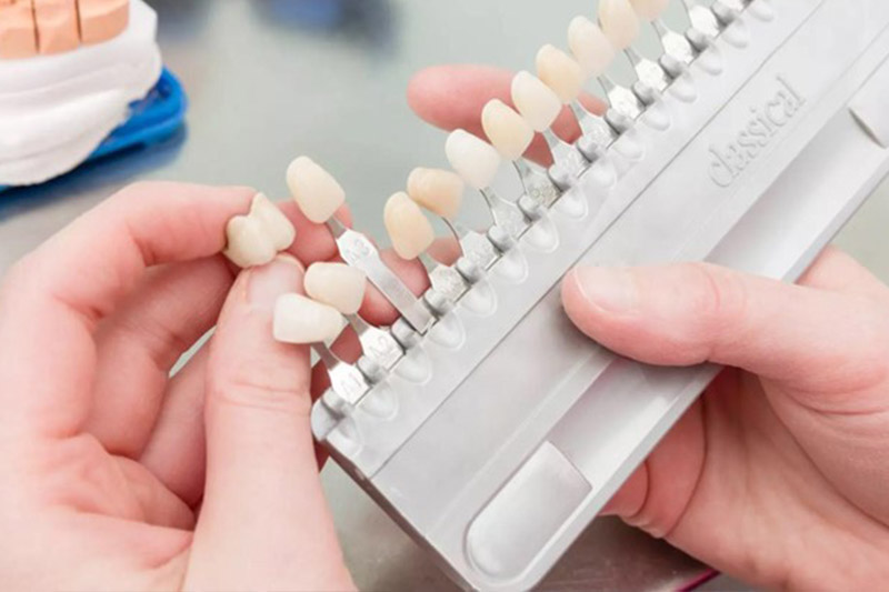 بهترین-رنگ-کامپوزیت-دندان