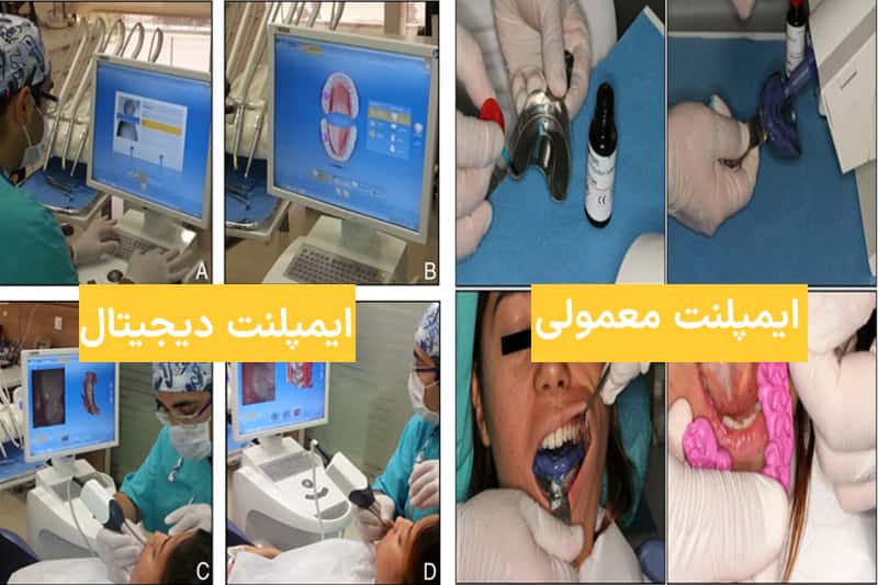 تفاوت-ایمپلنت-دیجیتال-و-معمولی