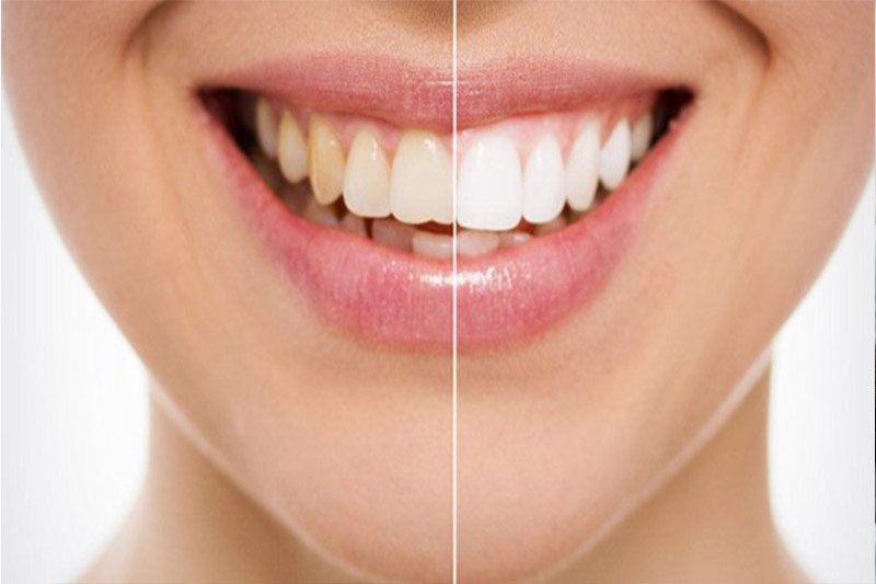 عوامل-مؤثر-بر-تغییر-رنگ-کامپوزیت-دندان