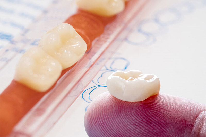 مینای-دندان-چیست-