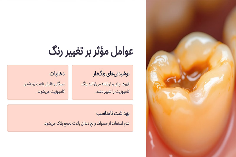 نکات-مهم-برای-ثابت-ماندن-رنگ-کامپوزیت-دندان