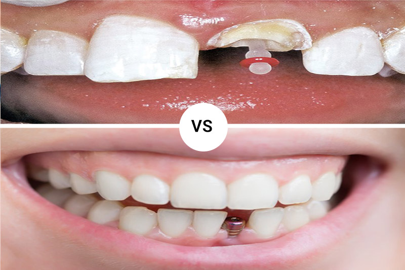 پست-دندان-بهتر-است-یا-ایمپلنت