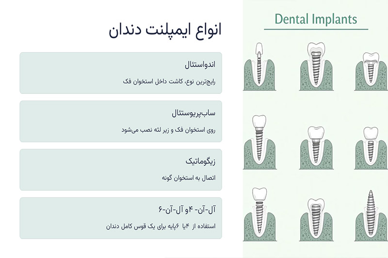 انواع-ایمپلنت-دندان
