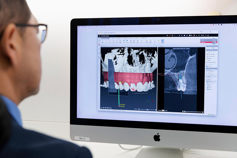 ایمپلنت-دیجیتال-چقدر-زمان-میبرد