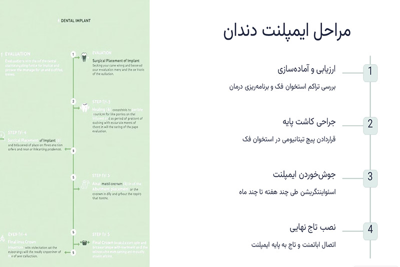 مراحل-ایمپلنت-دندان