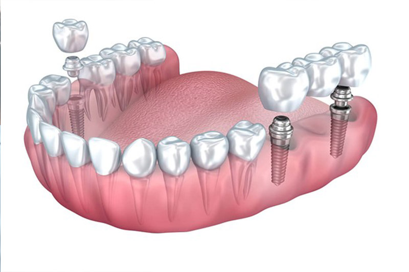 مراقبت-های-بعد-از-ایمپلنت-دندان