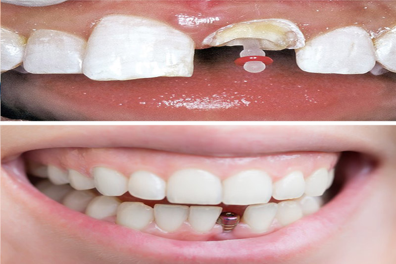 پست-دندان-بهتر-است-یا-ایمپلنت