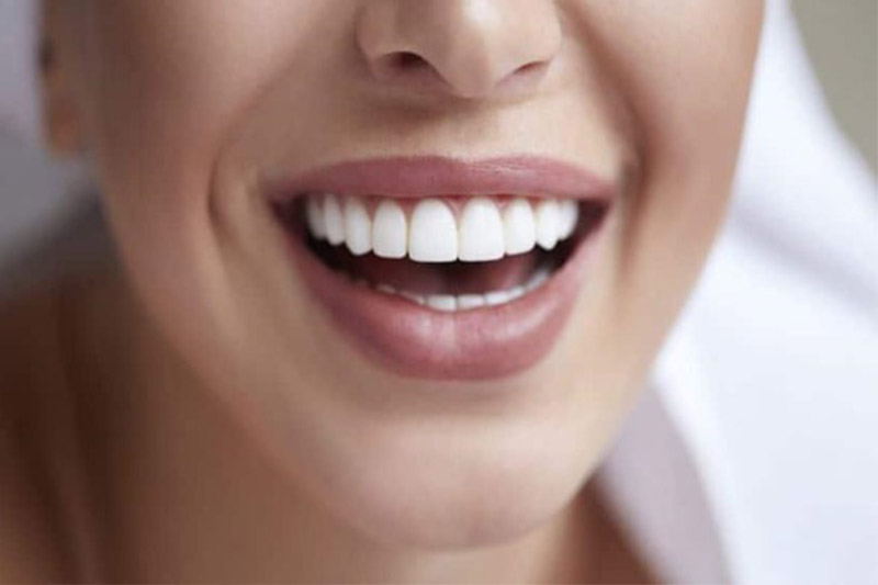 چگونه-دندان-کامپوزیت-شده-را-سفید-کنیم