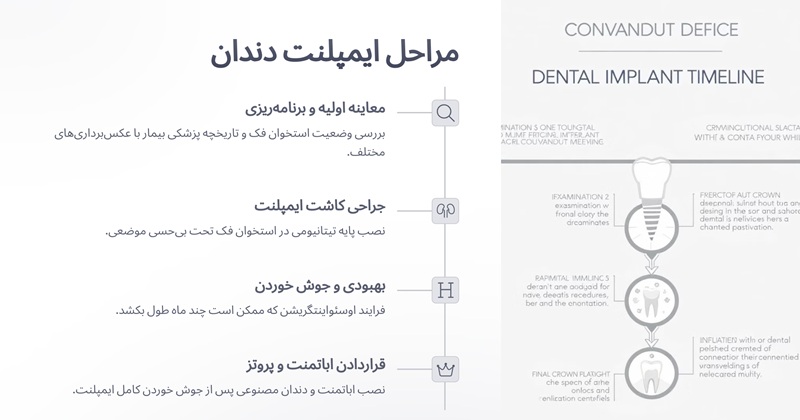 مراحل ایمپلنت